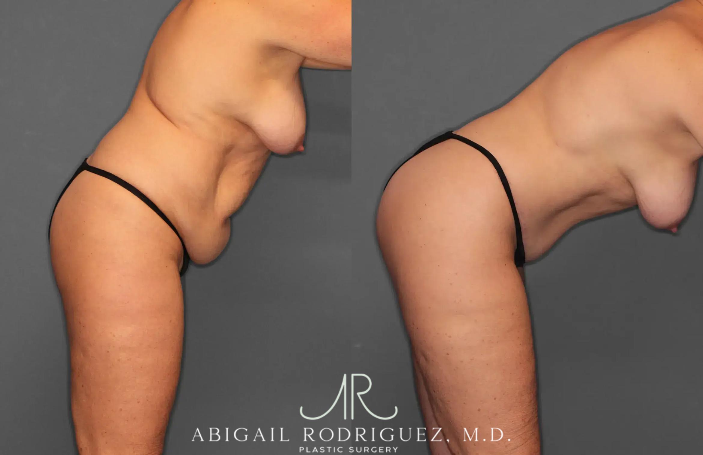 Before & After Tummy Tuck Case 259028 View 9 View in Houston, TX