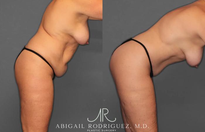 Before & After Tummy Tuck Case 259028 View 9 View in Houston, TX