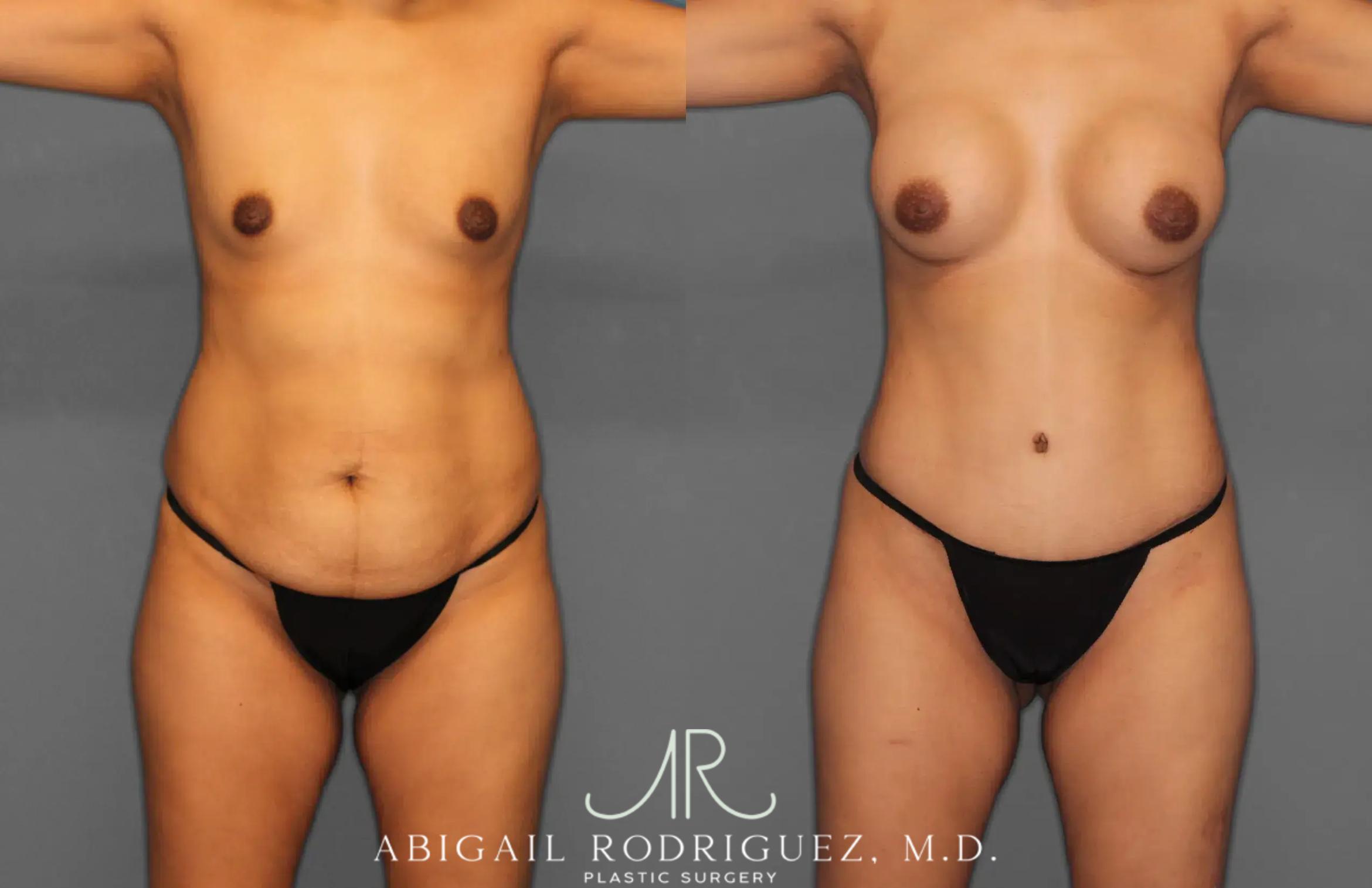 Before & After Tummy Tuck Case 259064 View 1 View in Houston, TX