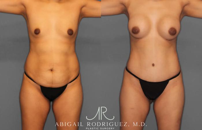 Before & After Tummy Tuck Case 259064 View 1 View in Houston, TX