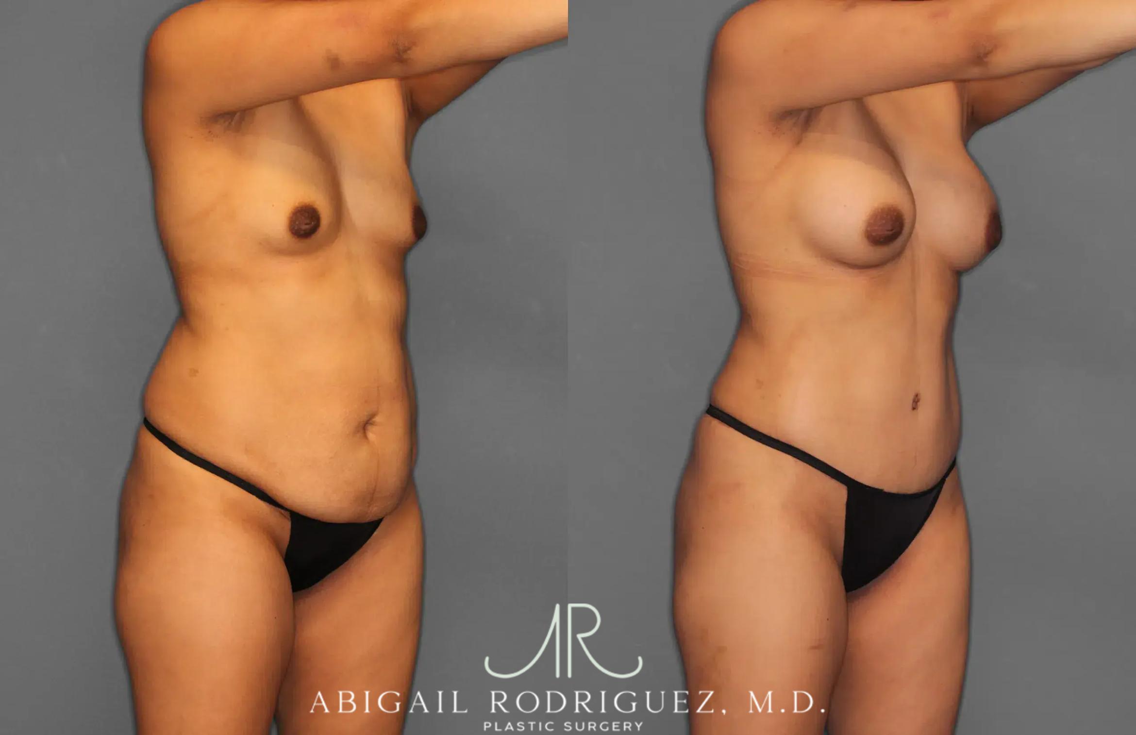 Before & After Tummy Tuck Case 259064 View 10 View in Houston, TX