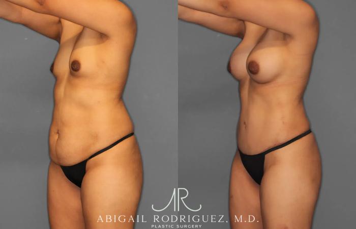 Before & After Tummy Tuck Case 259064 View 2 View in Houston, TX