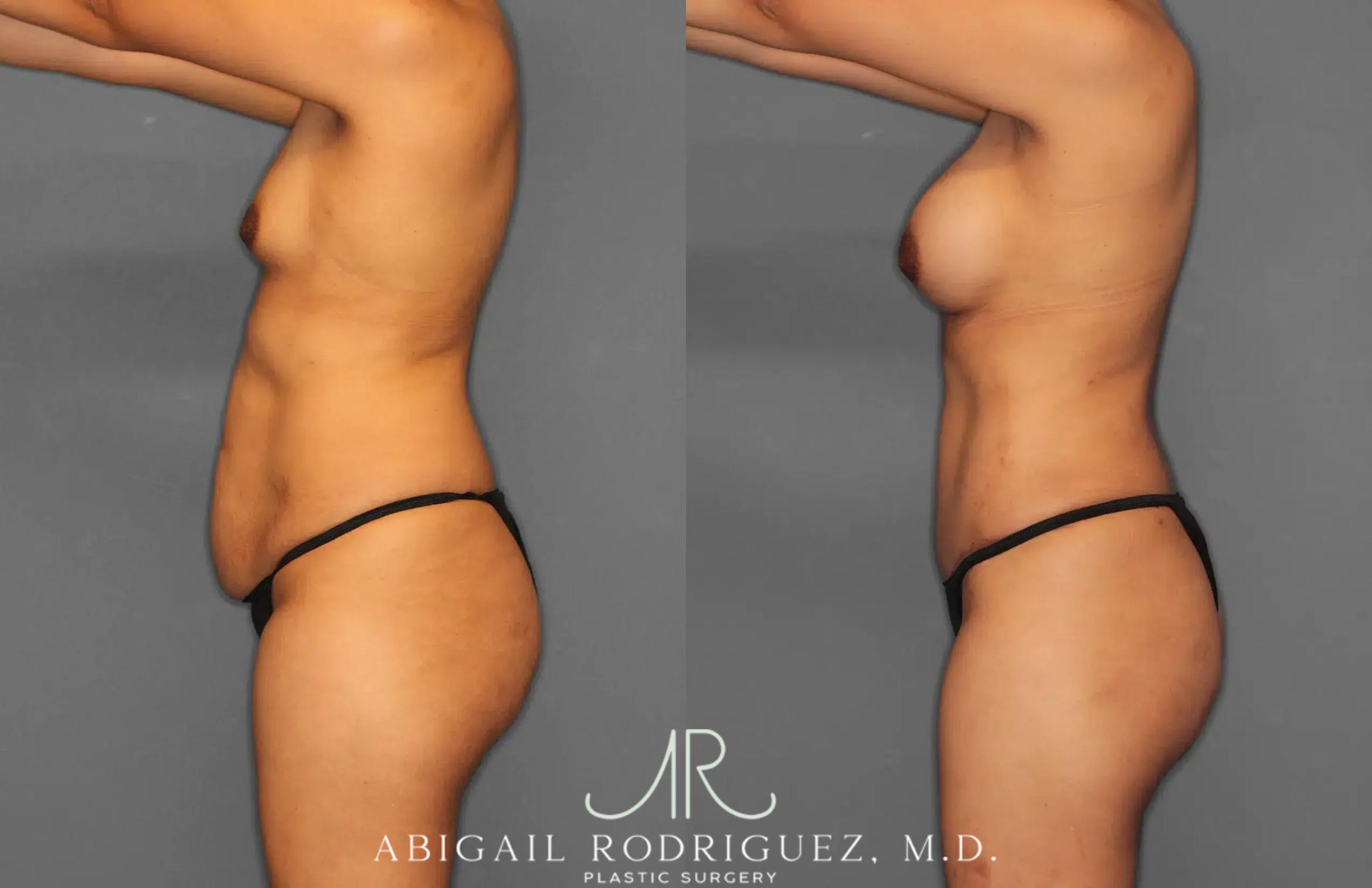 Before & After Tummy Tuck Case 259064 View 3 View in Houston, TX