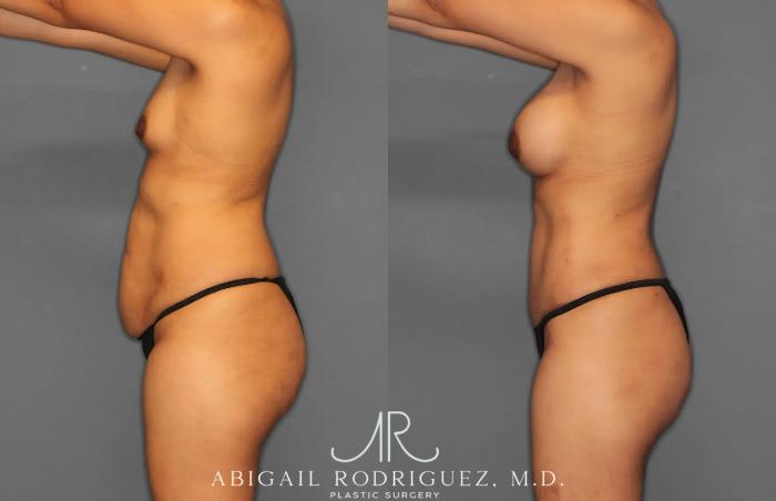 Before & After Tummy Tuck Case 259064 View 3 View in Houston, TX