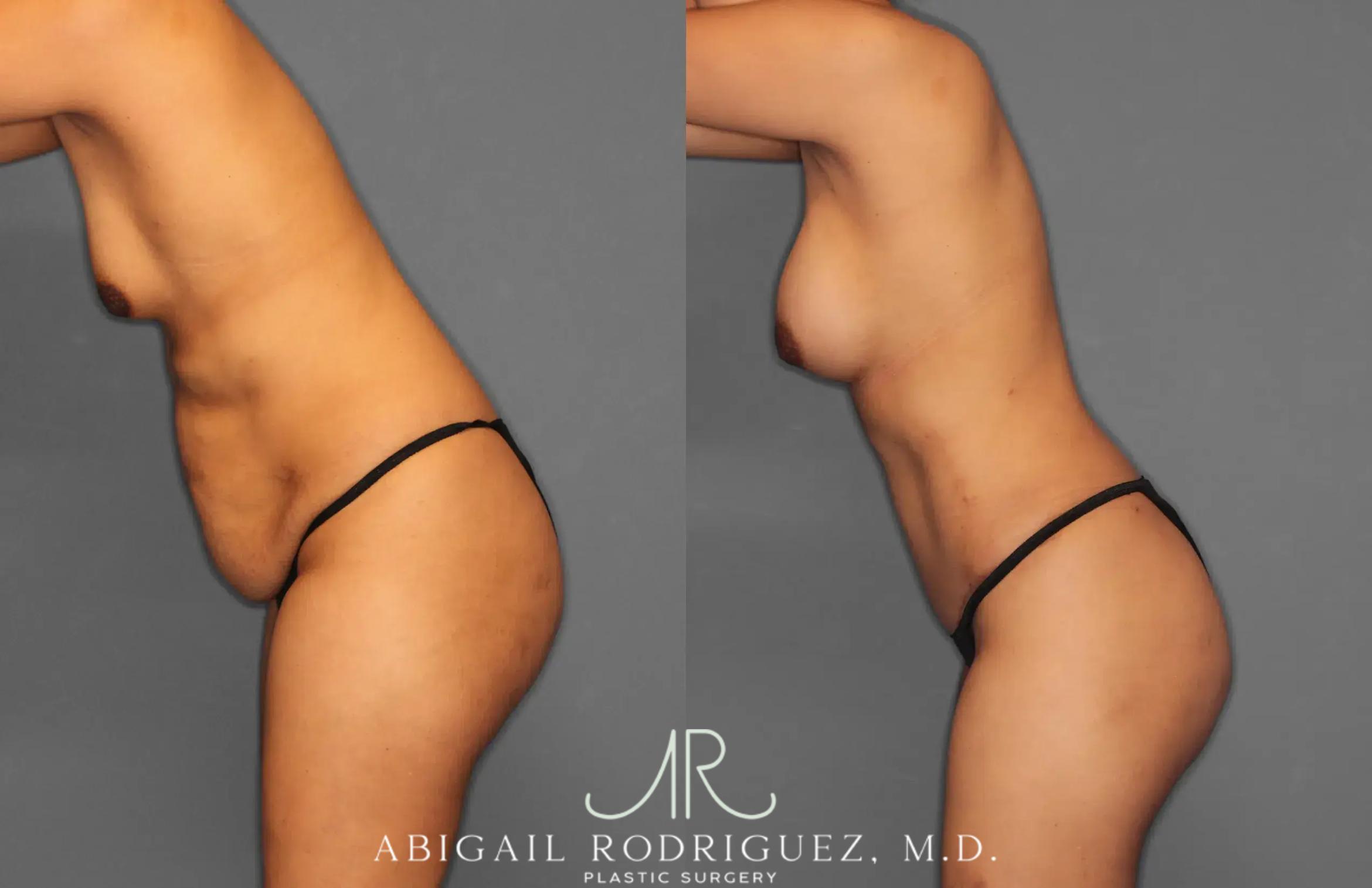 Before & After Tummy Tuck Case 259064 View 4 View in Houston, TX