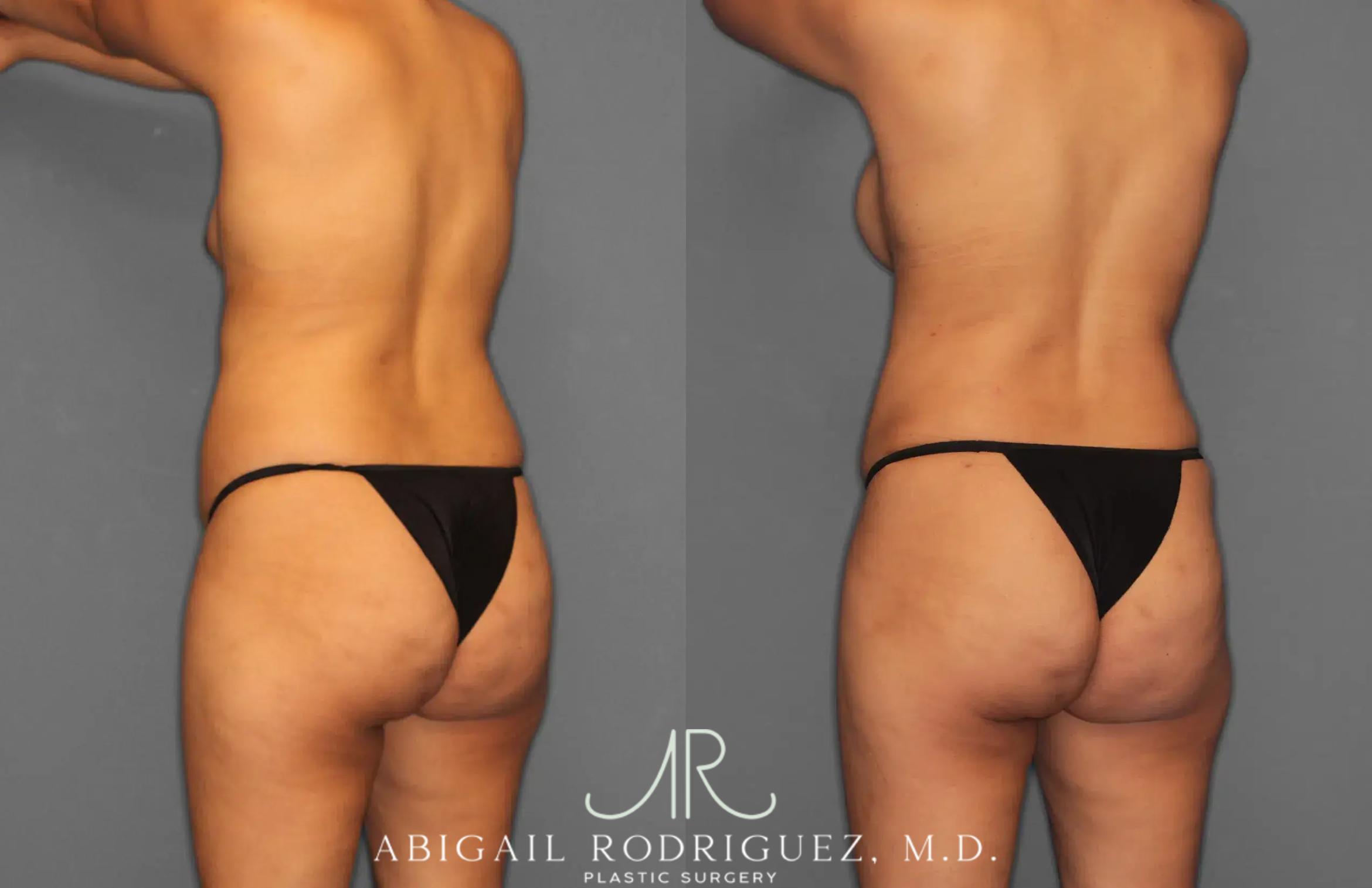 Before & After Tummy Tuck Case 259064 View 5 View in Houston, TX