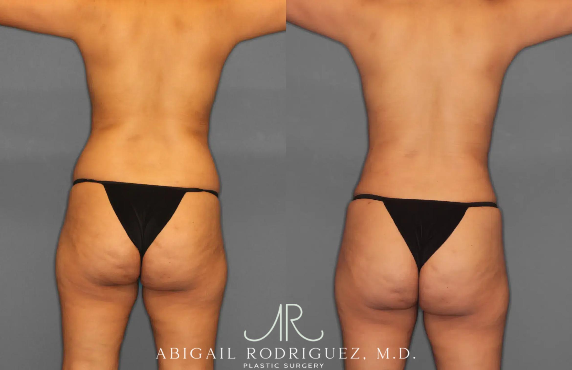 Before & After Tummy Tuck Case 259064 View 6 View in Houston, TX