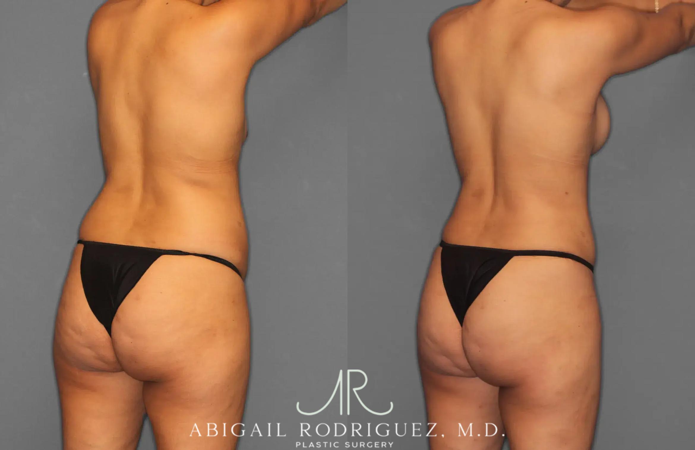 Before & After Tummy Tuck Case 259064 View 7 View in Houston, TX