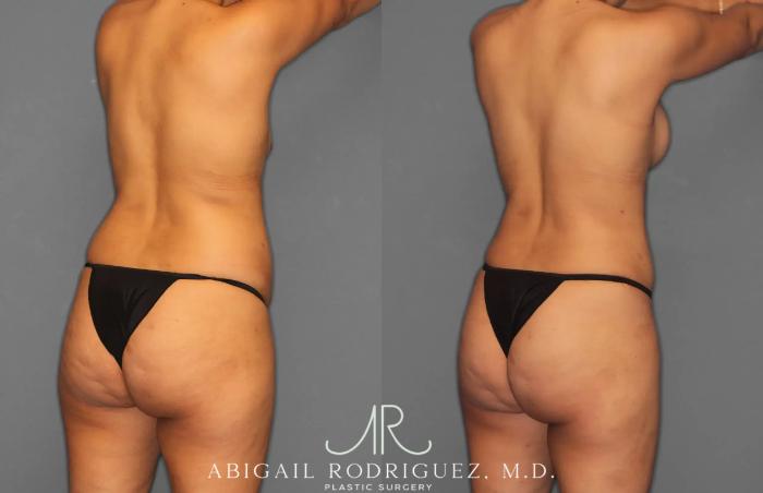 Before & After Tummy Tuck Case 259064 View 7 View in Houston, TX