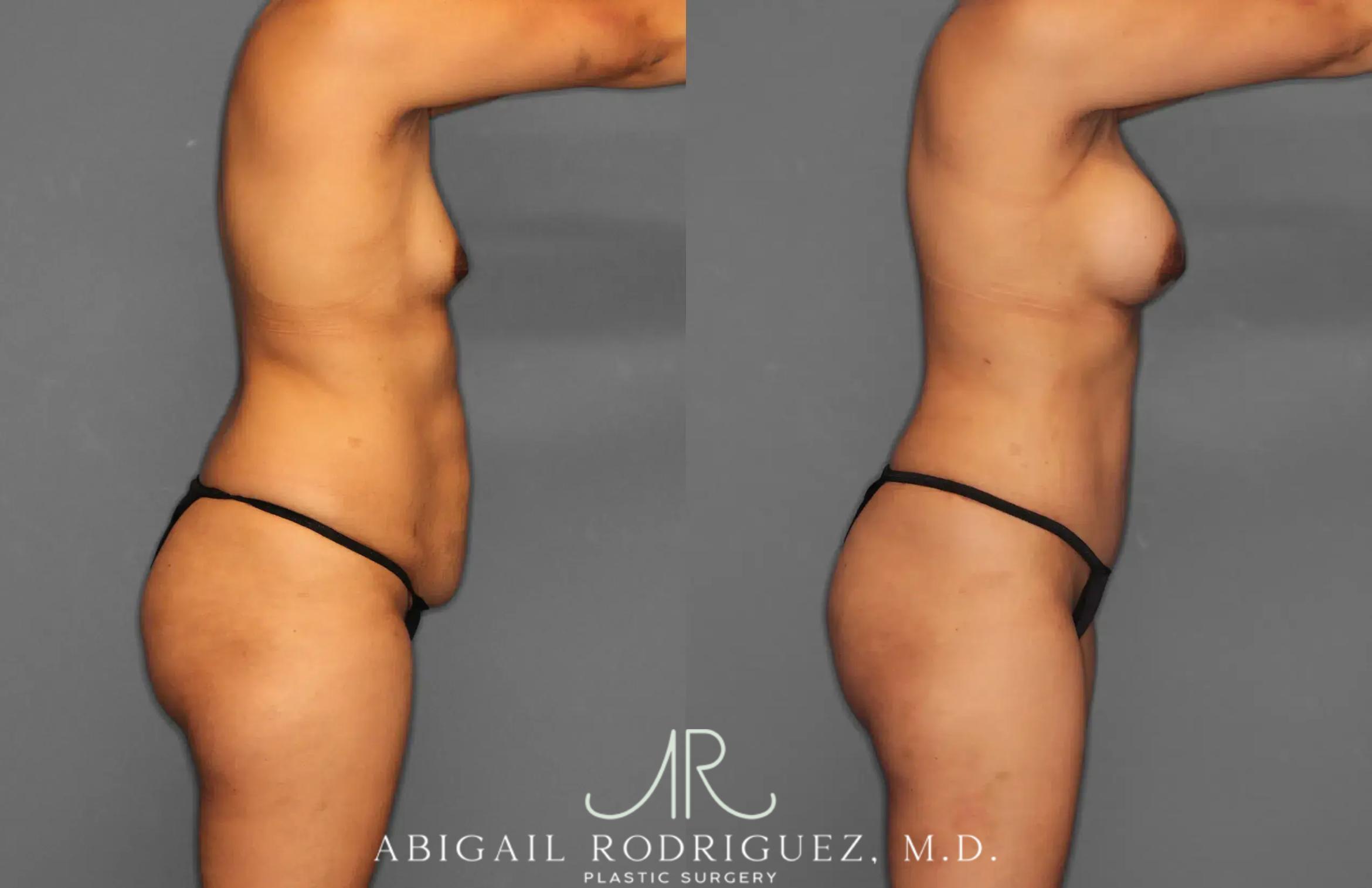 Before & After Tummy Tuck Case 259064 View 8 View in Houston, TX