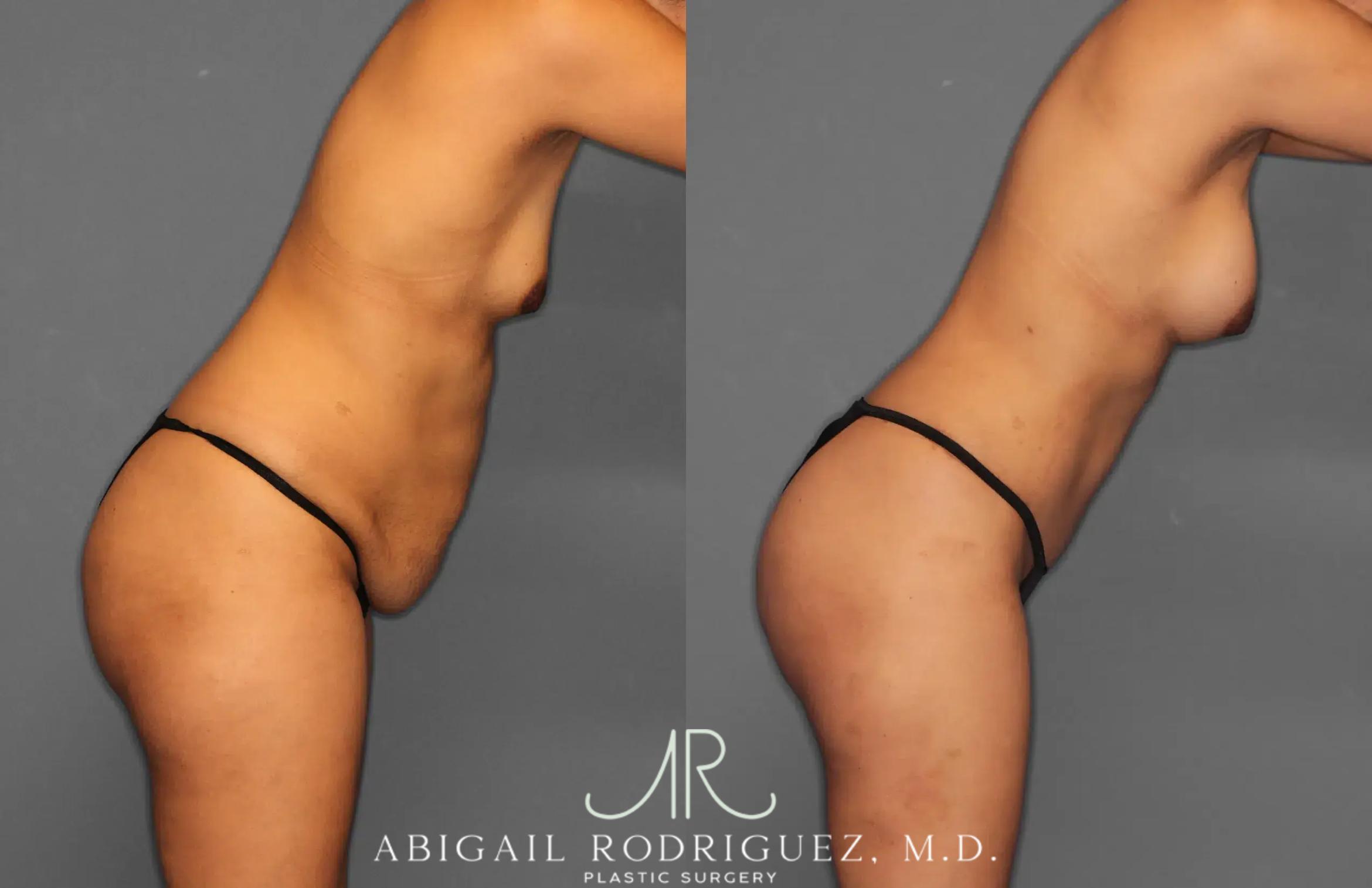 Before & After Tummy Tuck Case 259064 View 9 View in Houston, TX