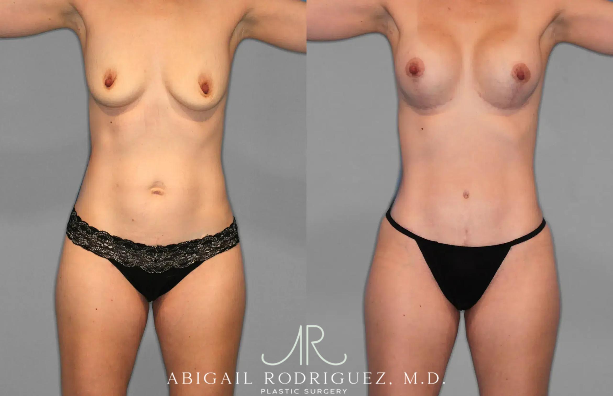 Before & After Tummy Tuck Case 259078 View 1 View in Houston, TX