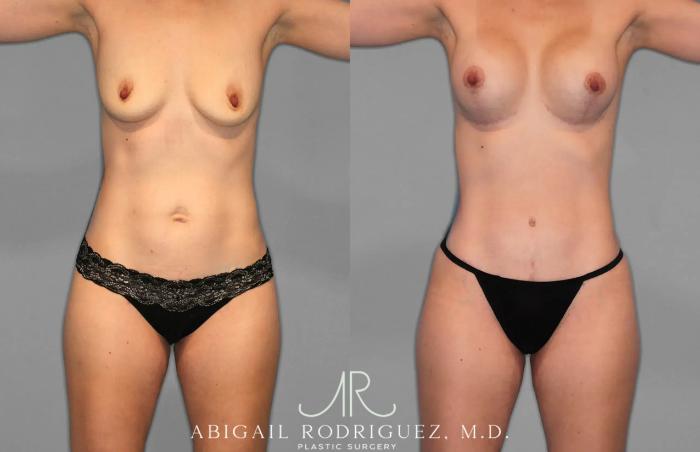 Before & After Tummy Tuck Case 259078 View 1 View in Houston, TX