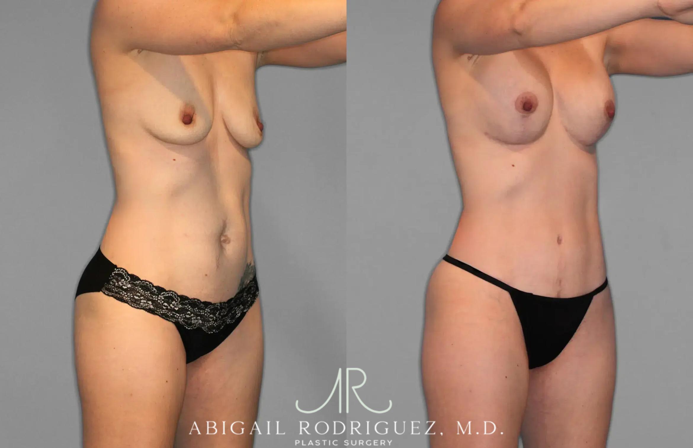 Before & After Tummy Tuck Case 259078 View 10 View in Houston, TX