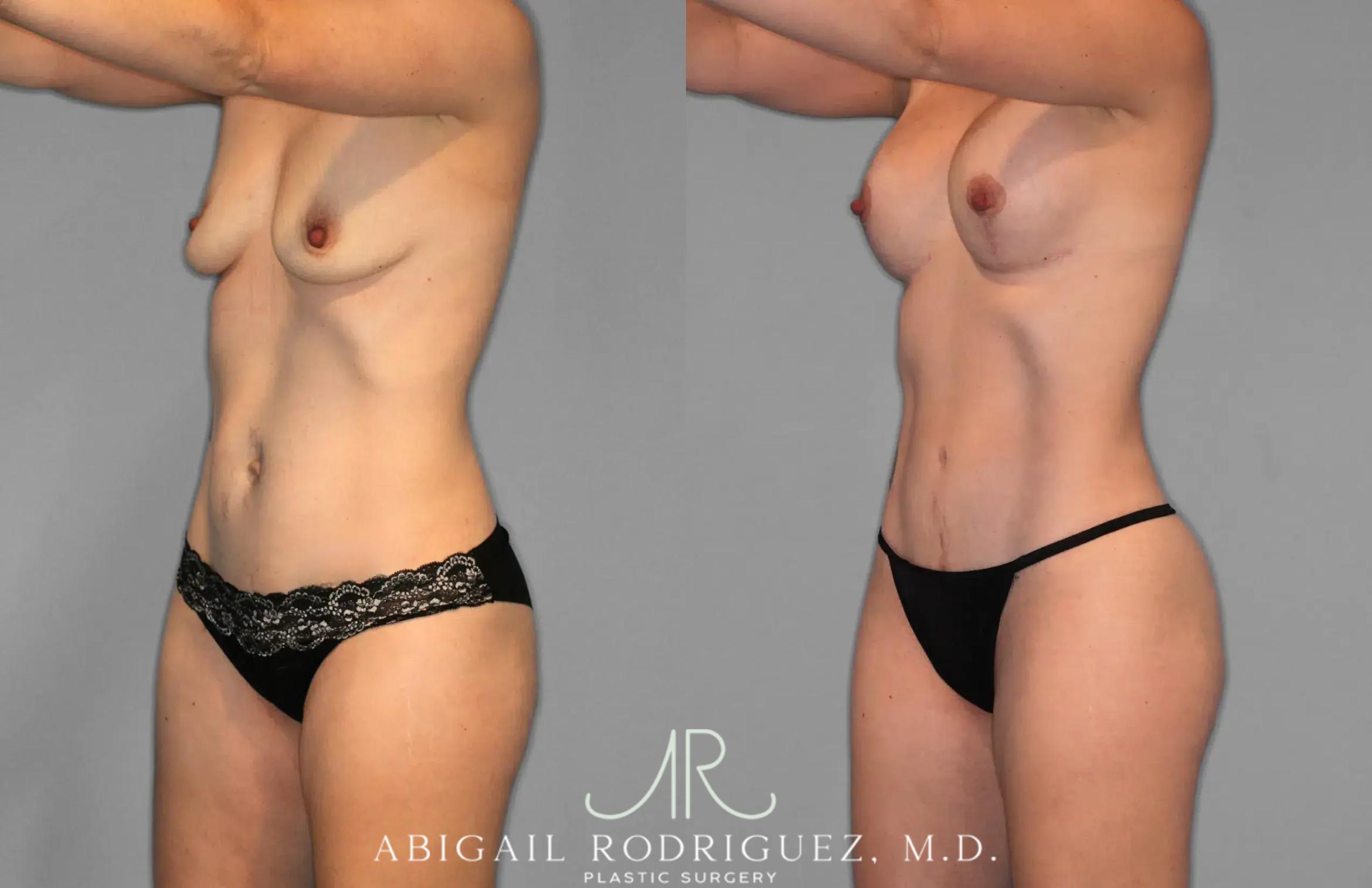 Before & After Tummy Tuck Case 259078 View 2 View in Houston, TX
