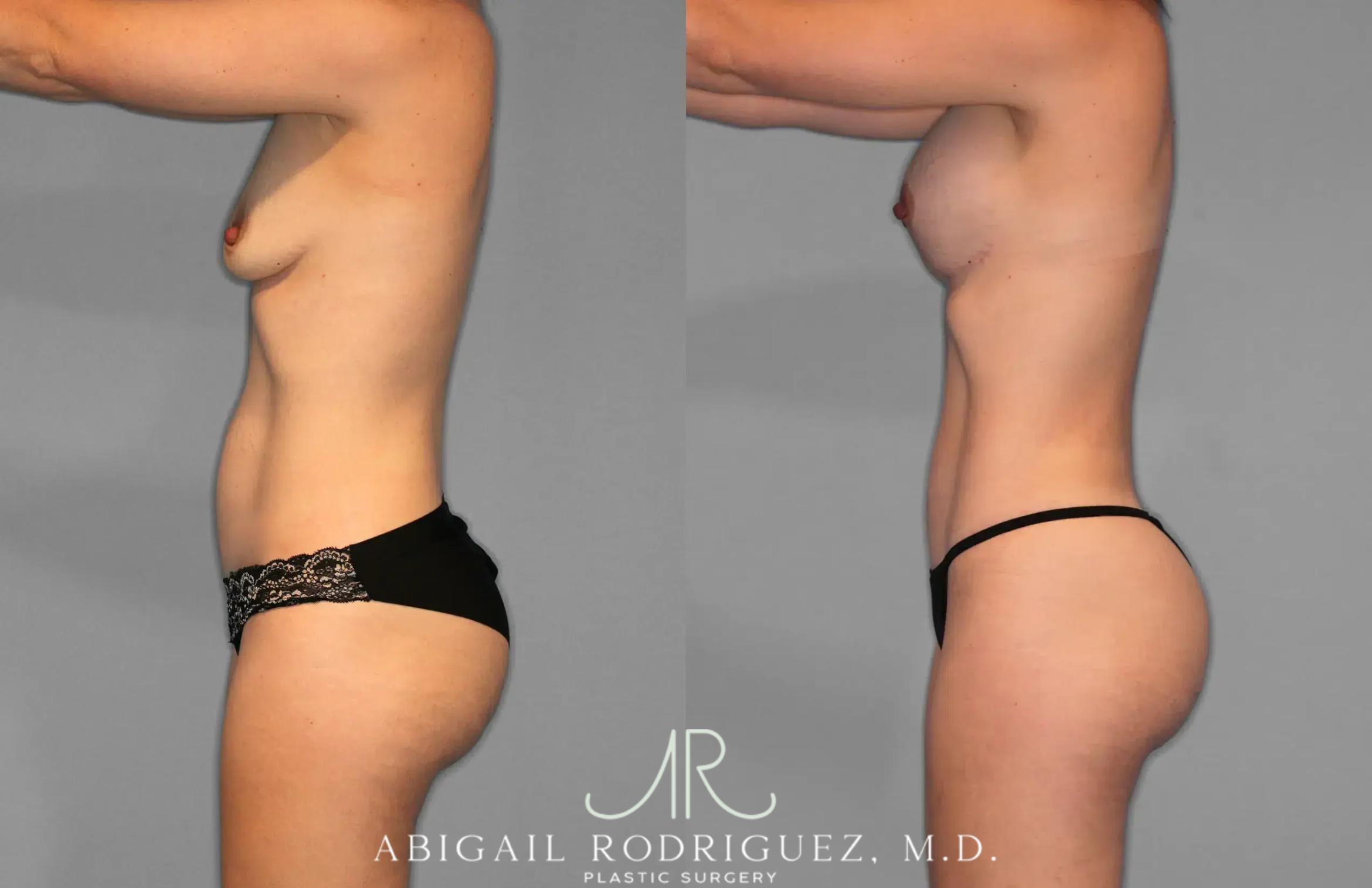 Before & After Tummy Tuck Case 259078 View 3 View in Houston, TX