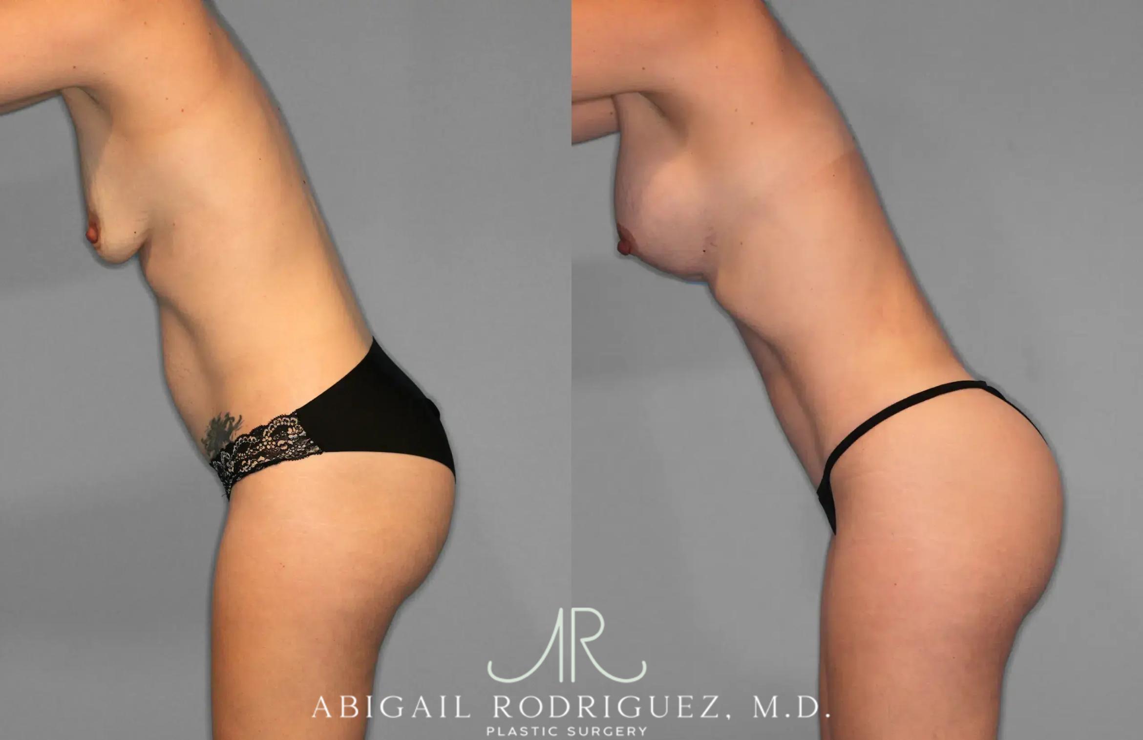 Before & After Tummy Tuck Case 259078 View 4 View in Houston, TX