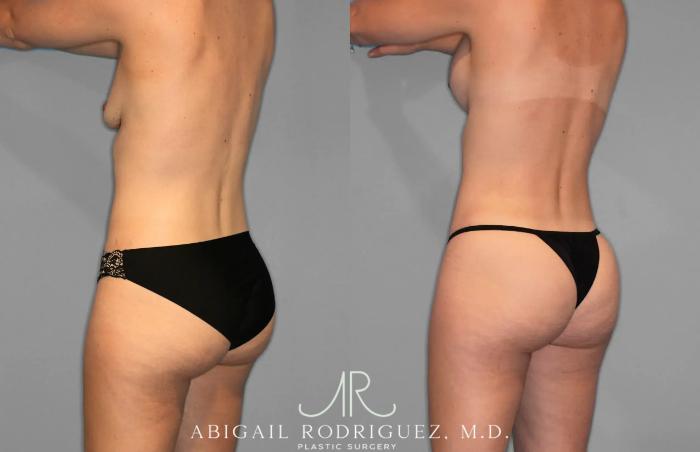 Before & After Tummy Tuck Case 259078 View 5 View in Houston, TX