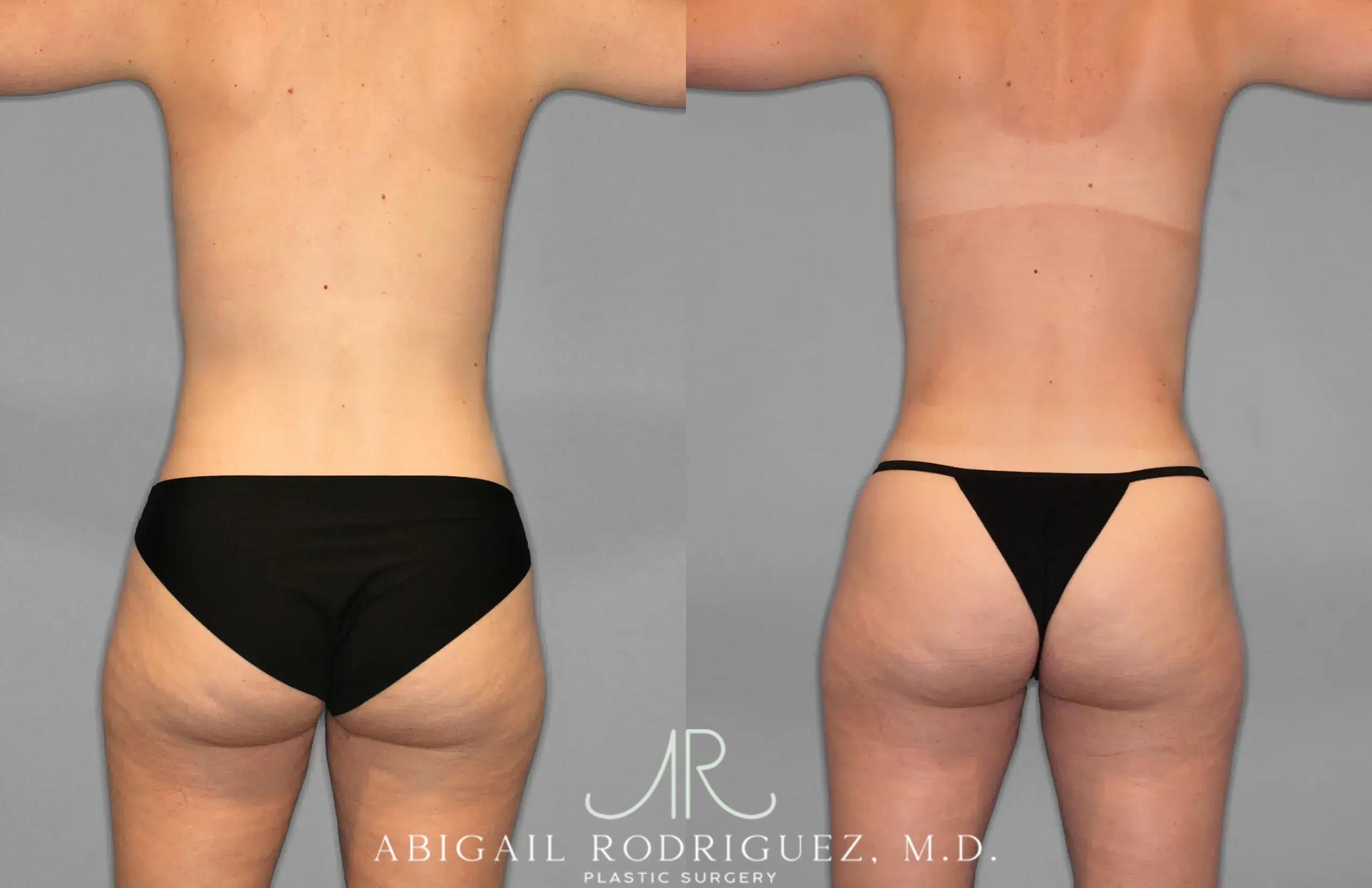 Before & After Tummy Tuck Case 259078 View 6 View in Houston, TX