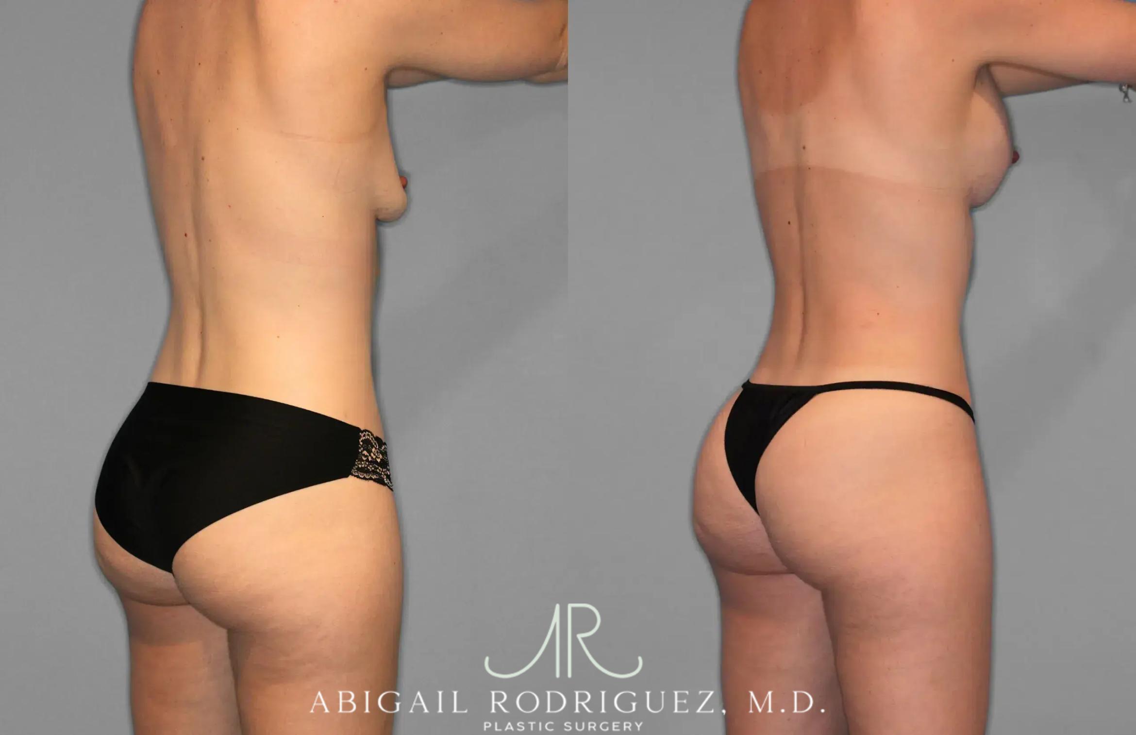 Before & After Tummy Tuck Case 259078 View 7 View in Houston, TX