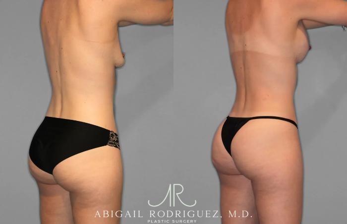 Before & After Tummy Tuck Case 259078 View 7 View in Houston, TX