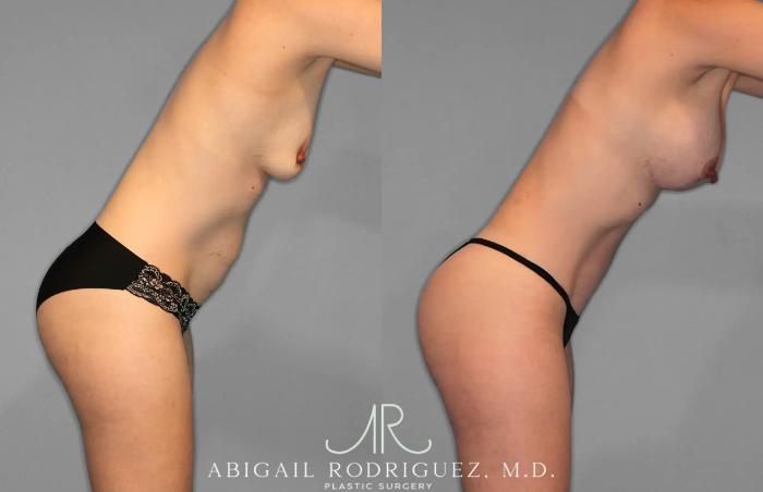 Before & After Tummy Tuck Case 259078 View 8 View in Houston, TX