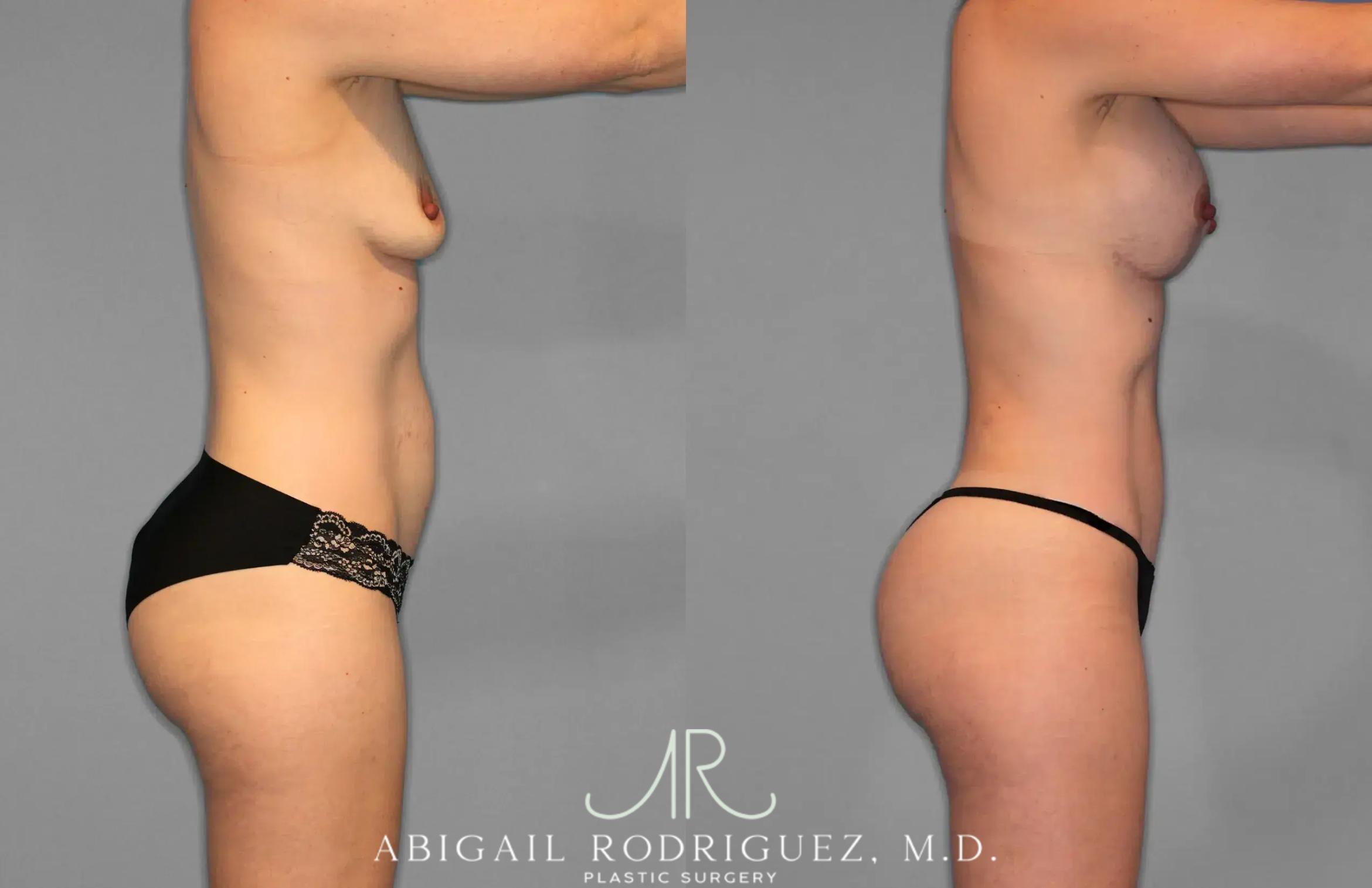 Before & After Tummy Tuck Case 259078 View 9 View in Houston, TX