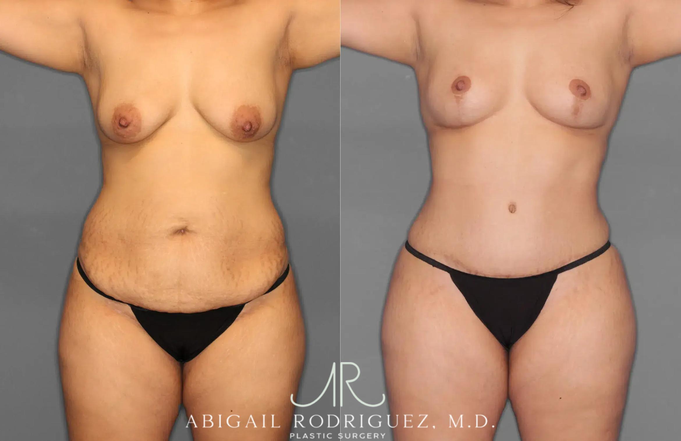 Before & After Tummy Tuck Case 259100 View 1 View in Houston, TX