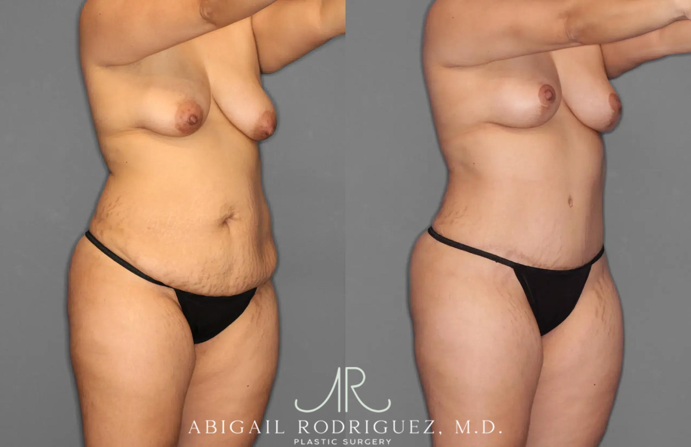 Before & After Tummy Tuck Case 259100 View 10 View in Houston, TX
