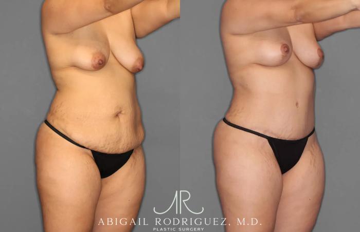 Before & After Tummy Tuck Case 259100 View 10 View in Houston, TX