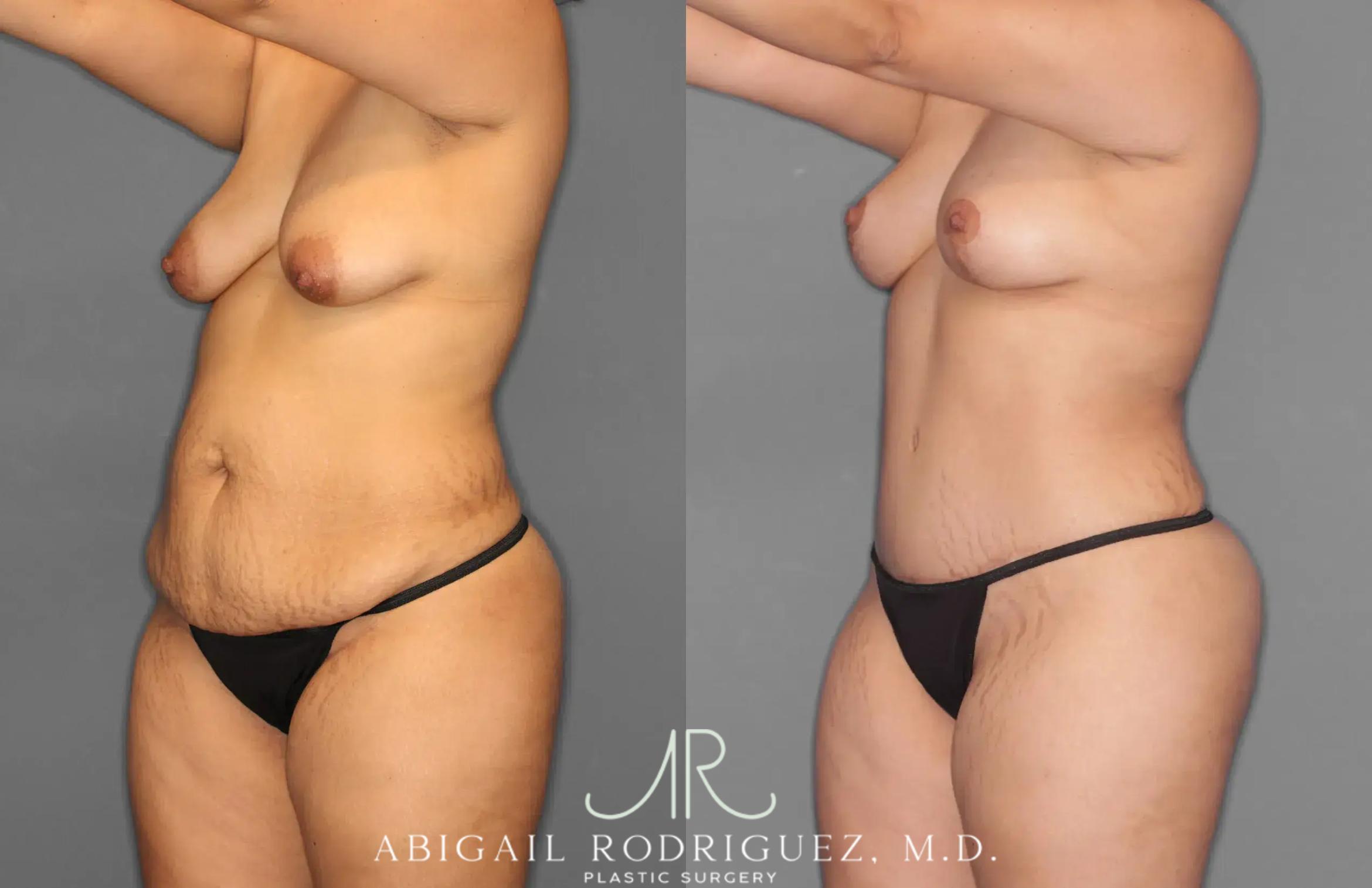 Before & After Tummy Tuck Case 259100 View 2 View in Houston, TX