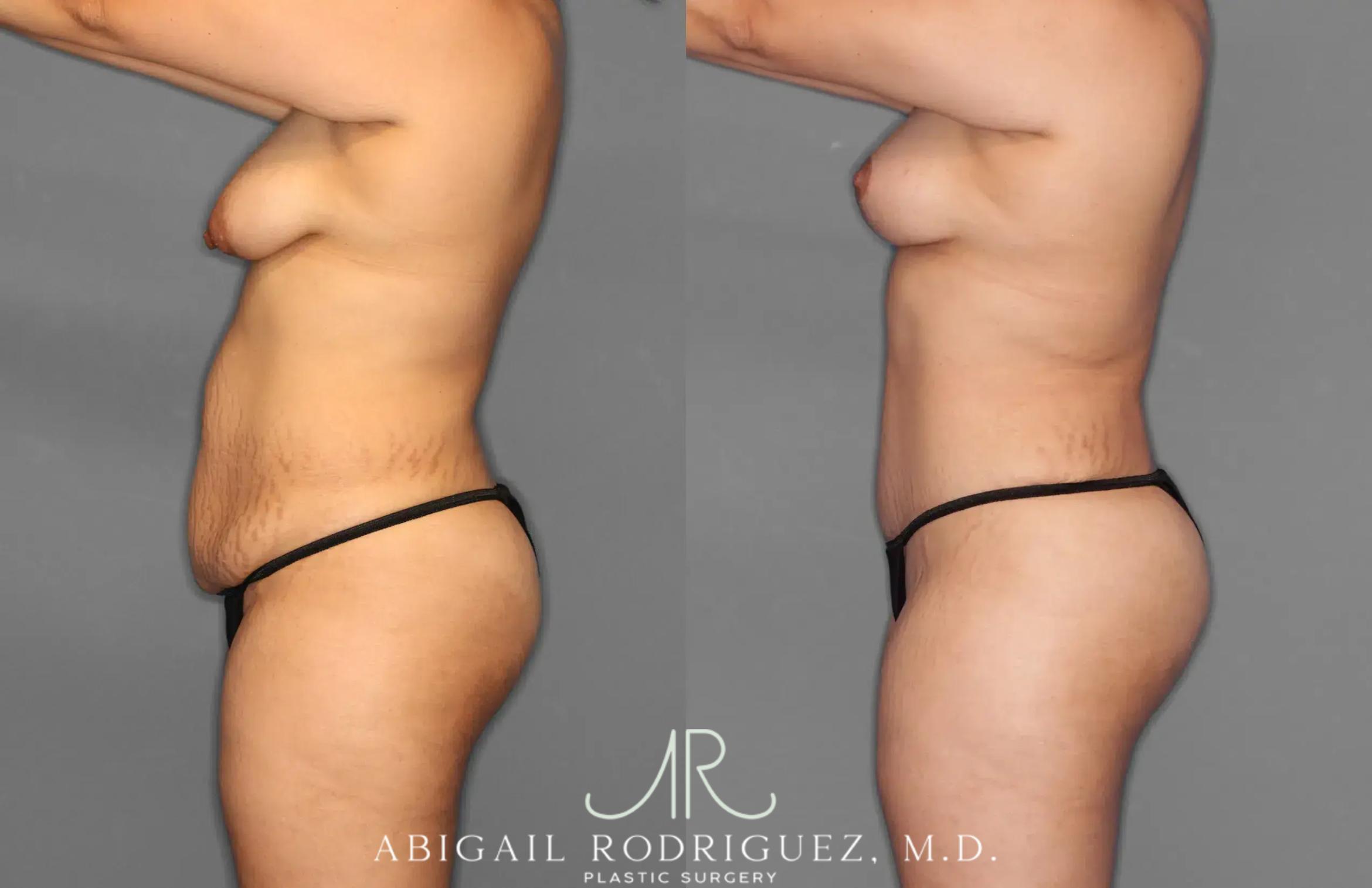 Before & After Tummy Tuck Case 259100 View 3 View in Houston, TX