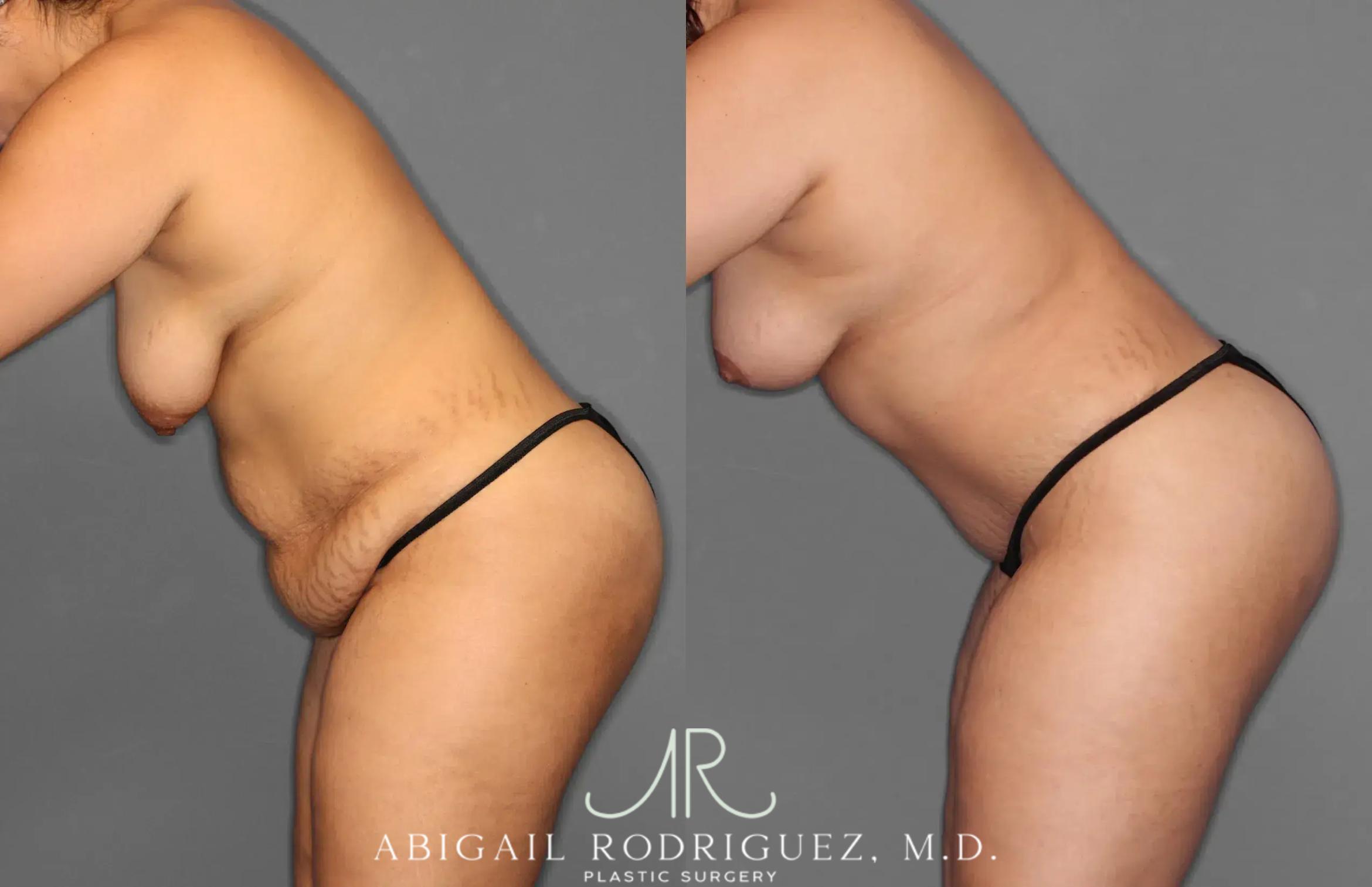 Before & After Tummy Tuck Case 259100 View 4 View in Houston, TX