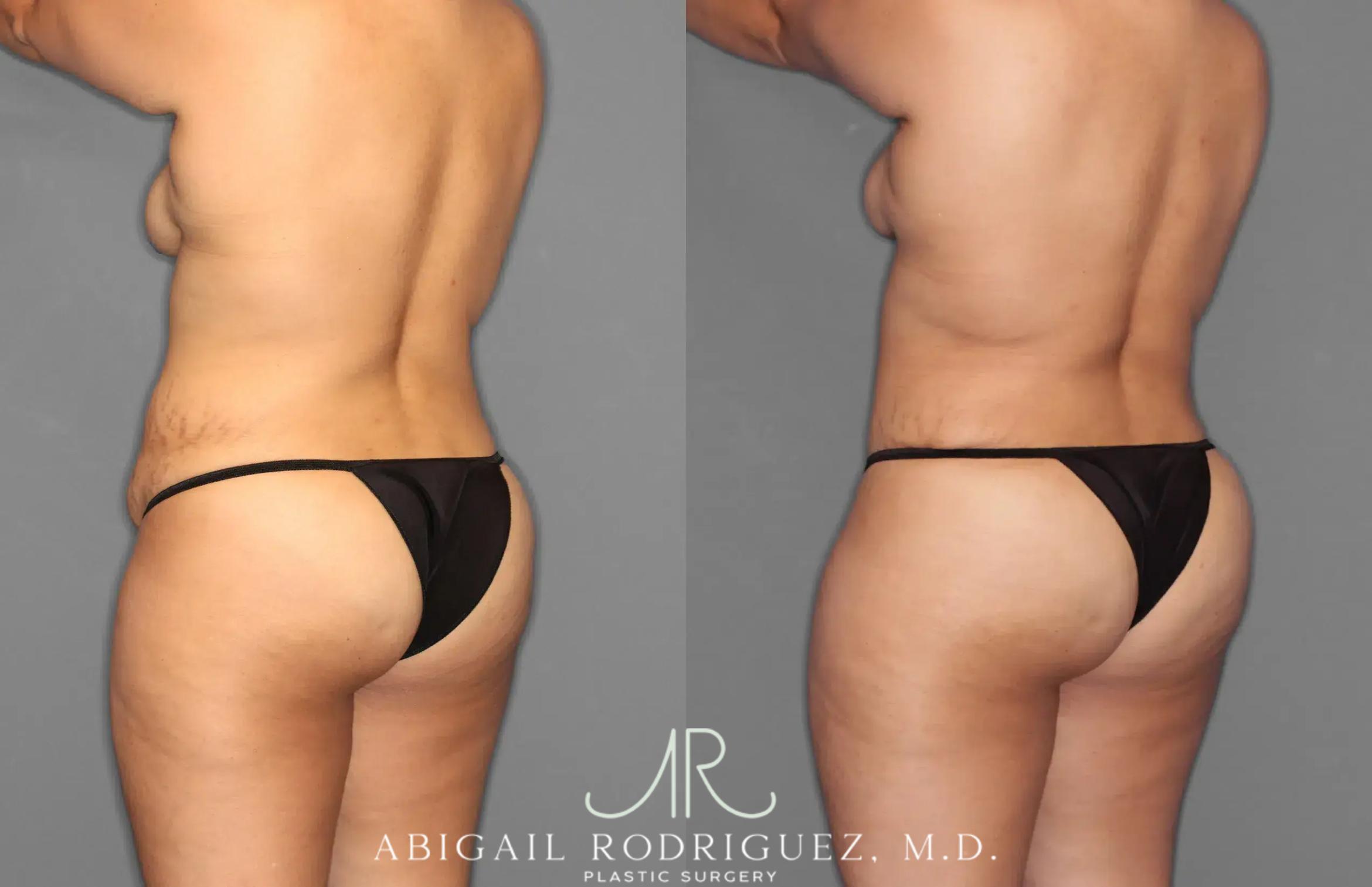 Before & After Tummy Tuck Case 259100 View 5 View in Houston, TX