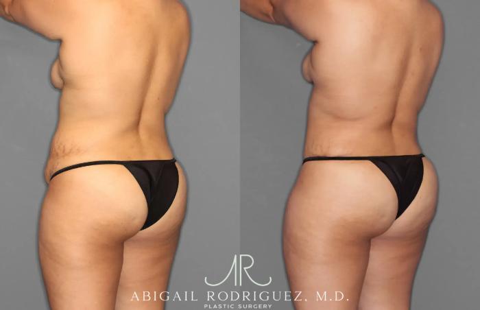 Before & After Tummy Tuck Case 259100 View 5 View in Houston, TX