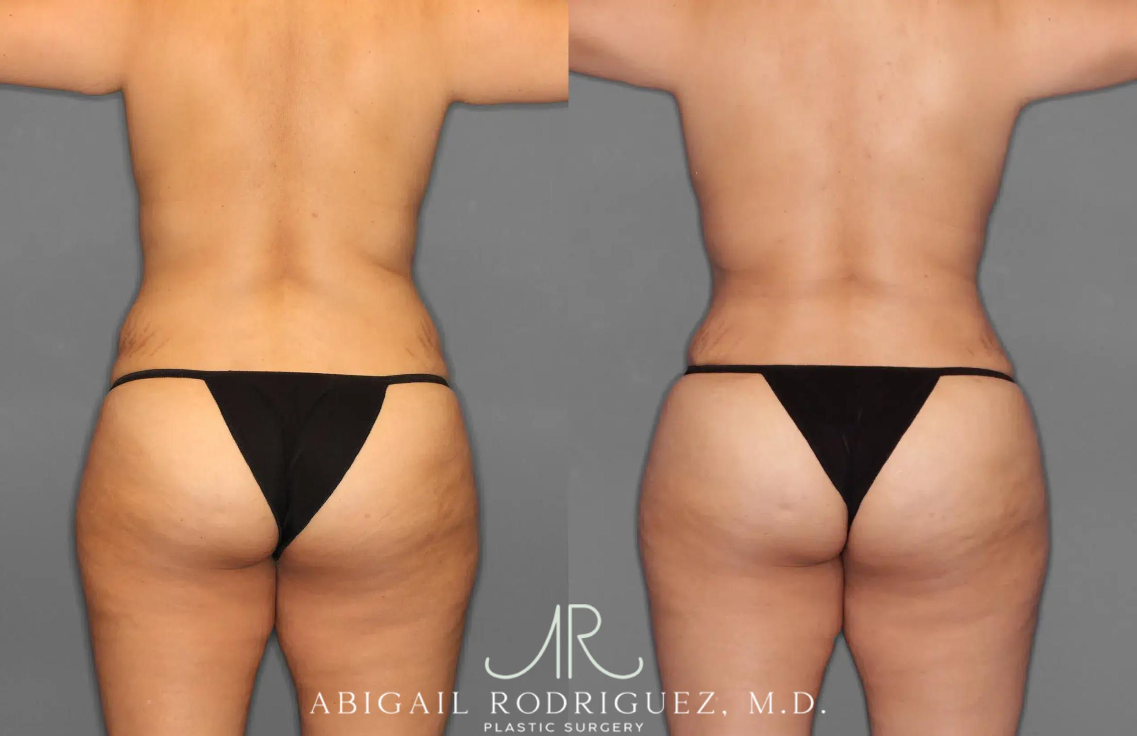 Before & After Tummy Tuck Case 259100 View 6 View in Houston, TX