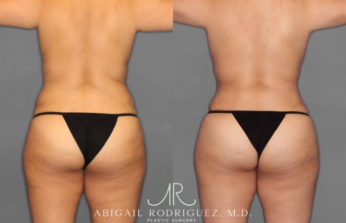 Before & After Tummy Tuck Case 259100 View 6 View in Houston, TX