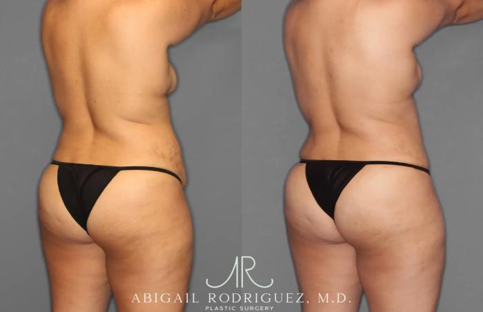 Before & After Tummy Tuck Case 259100 View 7 View in Houston, TX