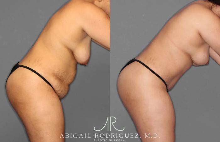 Before & After Tummy Tuck Case 259100 View 8 View in Houston, TX