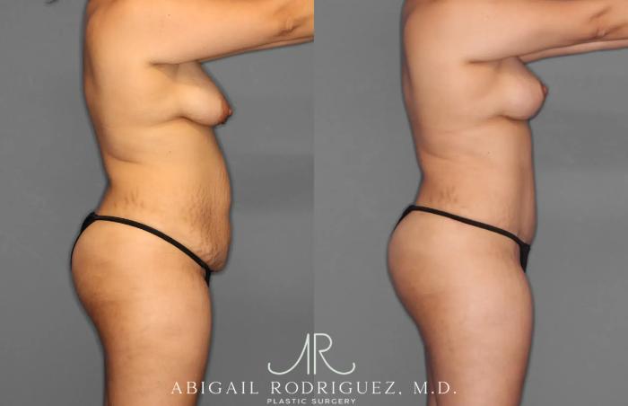 Before & After Tummy Tuck Case 259100 View 9 View in Houston, TX