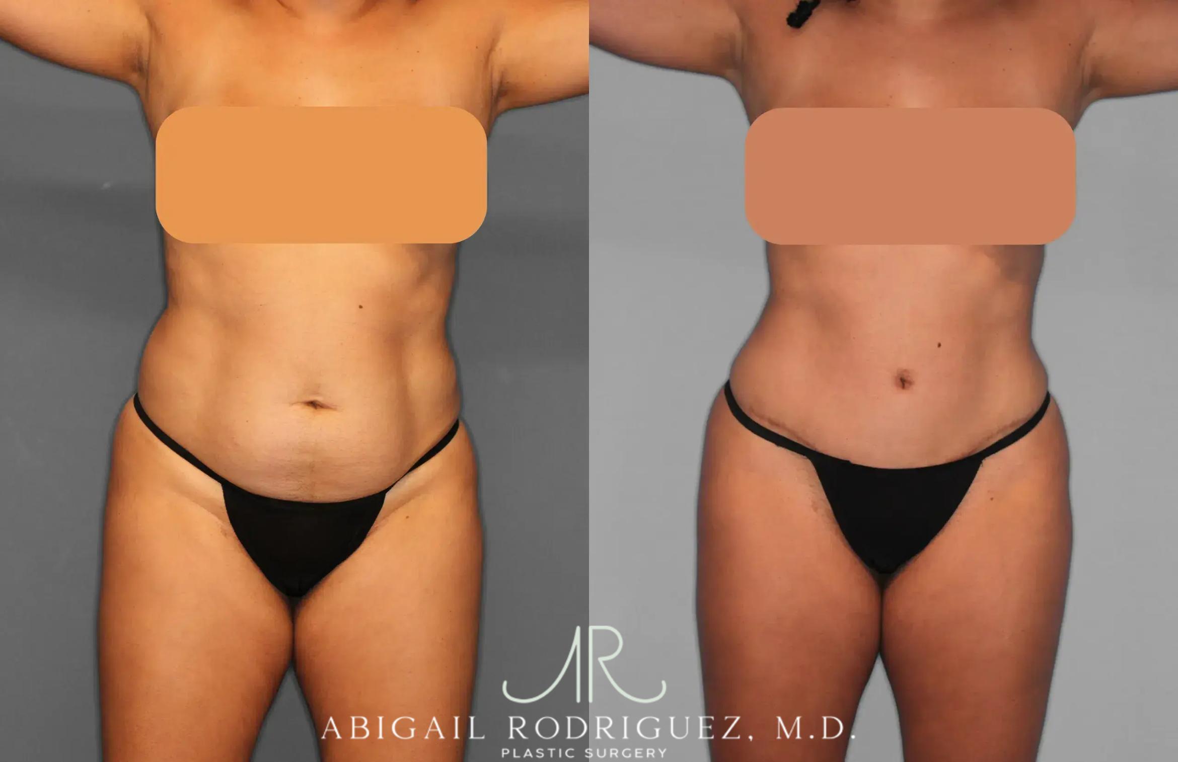 Before & After Tummy Tuck Case 259134 View 1 View in Houston, TX