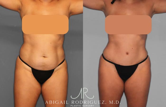 Before & After Tummy Tuck Case 259134 View 1 View in Houston, TX