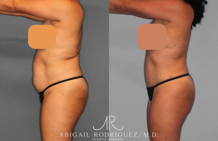 Before & After Tummy Tuck Case 259134 View 2 View in Houston, TX