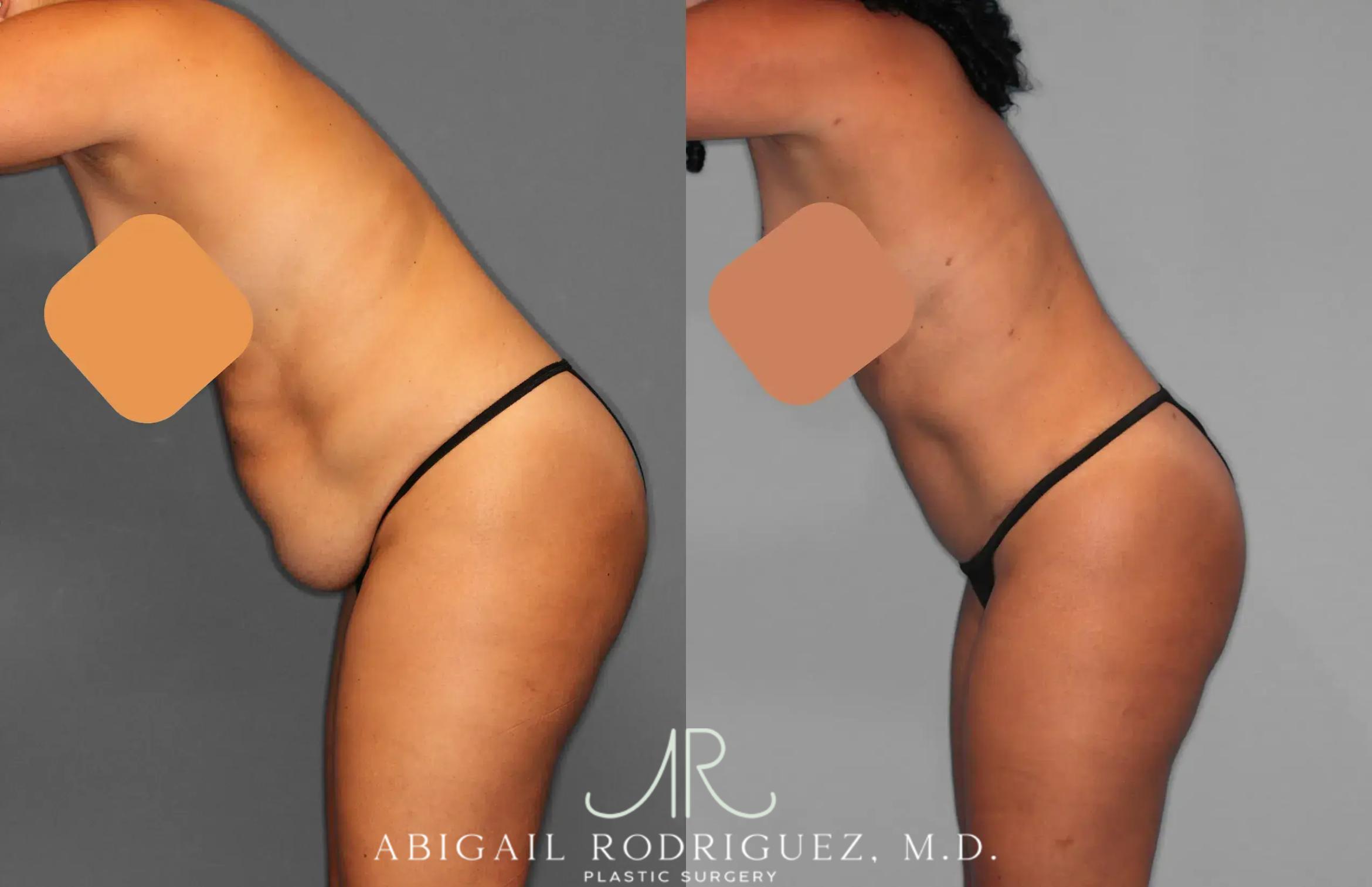 Before & After Tummy Tuck Case 259134 View 3 View in Houston, TX