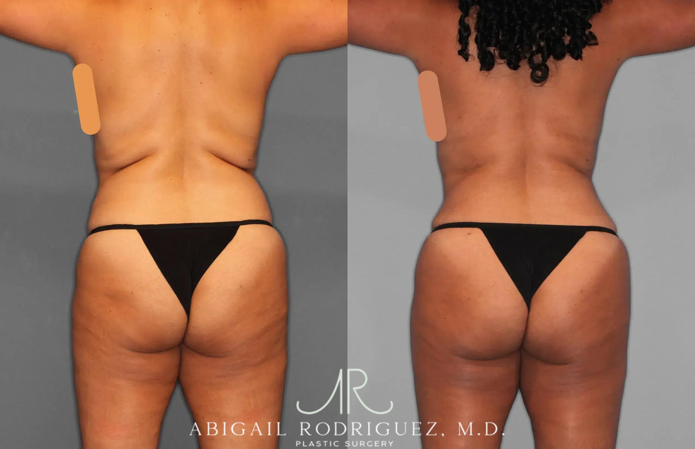 Before & After Tummy Tuck Case 259134 View 4 View in Houston, TX