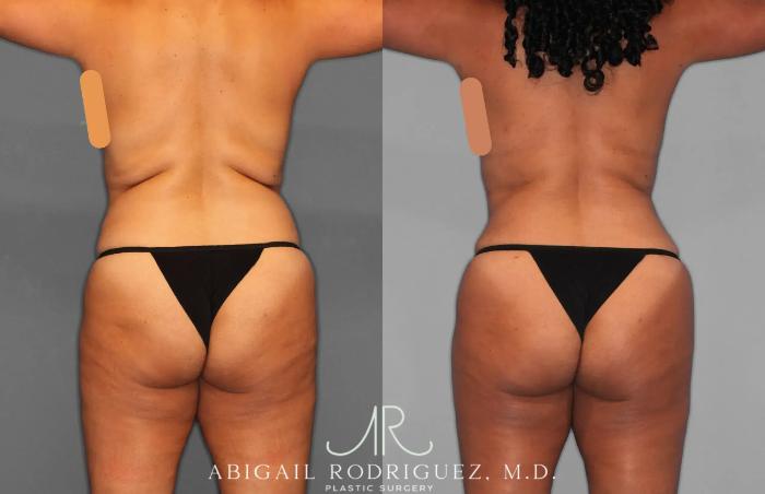 Before & After Tummy Tuck Case 259134 View 4 View in Houston, TX