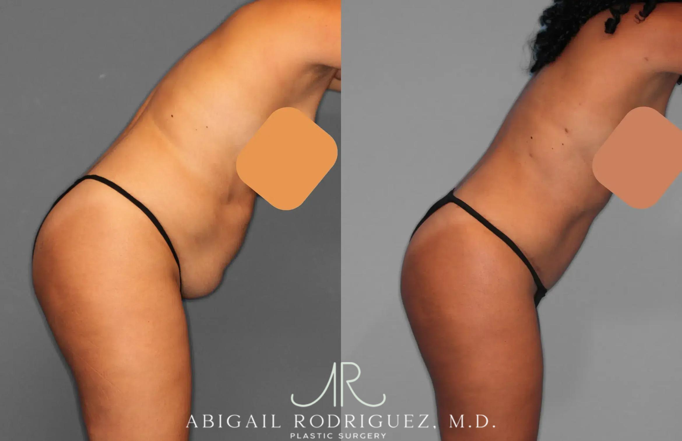 Before & After Tummy Tuck Case 259134 View 5 View in Houston, TX