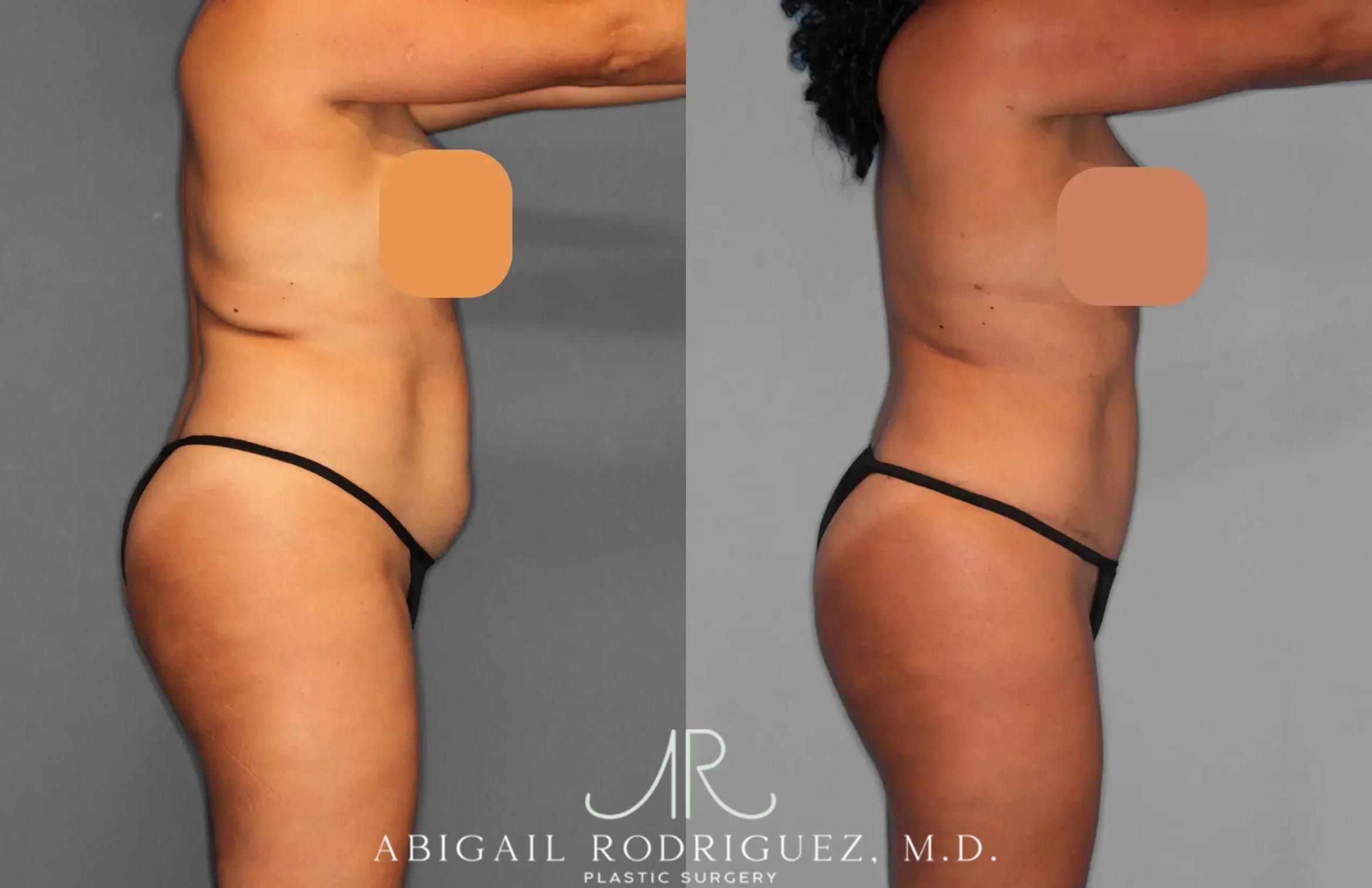 Before & After Tummy Tuck Case 259134 View 6 View in Houston, TX
