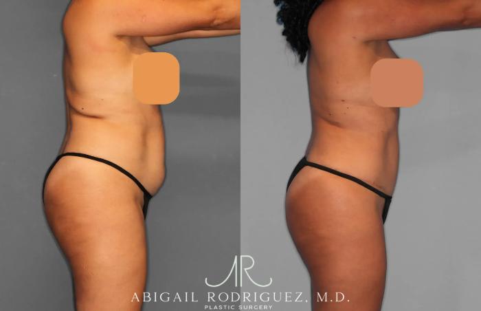 Before & After Tummy Tuck Case 259134 View 6 View in Houston, TX
