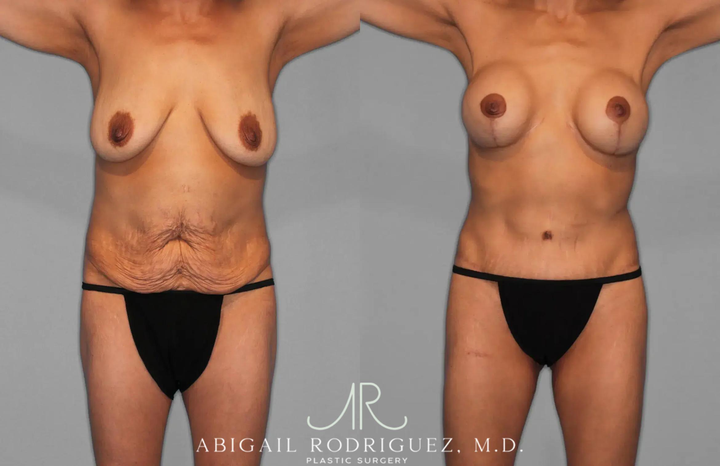 Before & After Tummy Tuck Case 259145 View 1 View in Houston, TX